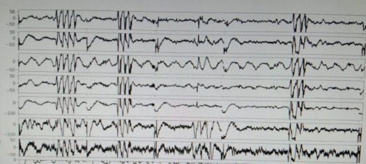 PiEEG captured data chewing blinking eyes PiEEG captured data chewing blinking eyes